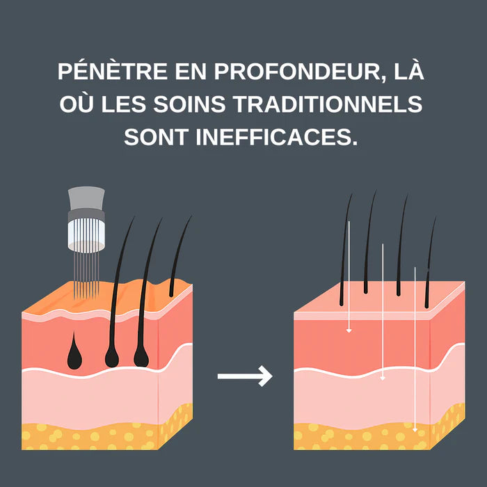 TRAITEMENT CAPILLAIRE - MICROROOT®